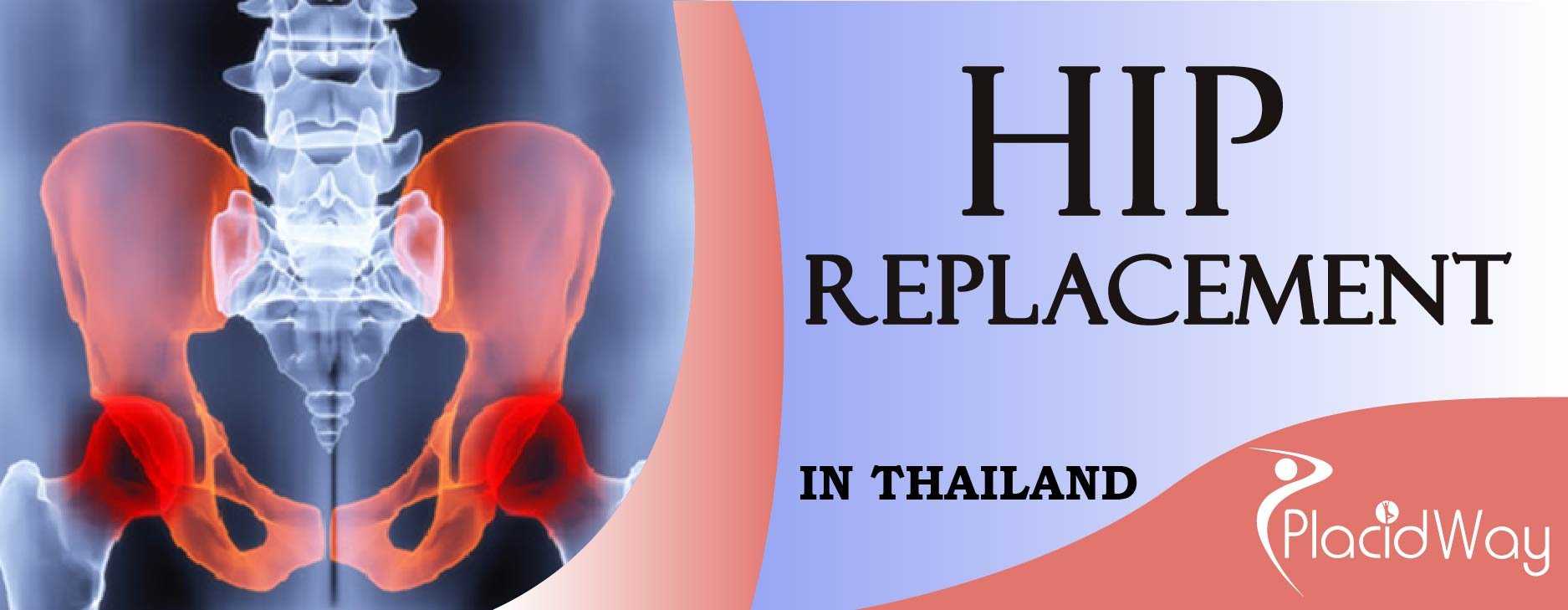 Hip Replacement in Thailand, Orthopedic Surgery in Thailand